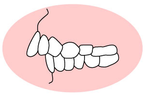 空隙歯列(くうげきしれつ)「すきっ歯」
