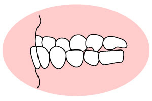 叢生(そうせい)「凸凹の歯並び」