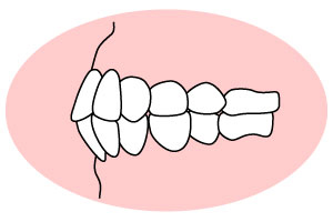 過蓋咬合(かがいこうごう)「上の歯が深く被さっている」