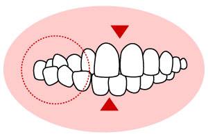 開咬(かいこう)「上下の前歯が閉じない」