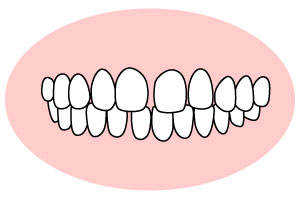 空隙歯列(くうげきしれつ)「すきっ歯」