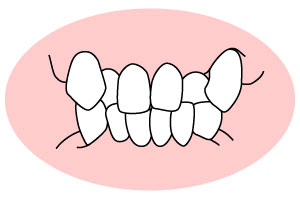 叢生(そうせい)「凸凹の歯並び」