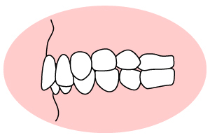 過蓋咬合(かがいこうごう)「上の歯が深く被さっている」