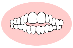 開咬(かいこう)「上下の前歯が閉じない」